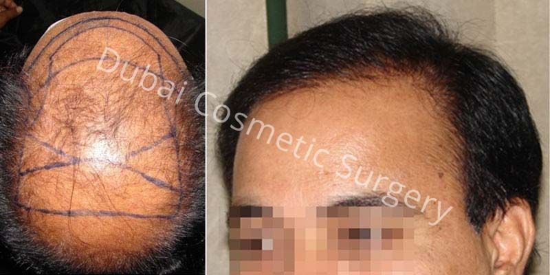 Before And After | Dubai Cosmetic Surgery