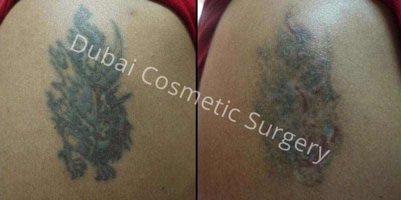 Tattoo Removal Cream In Sri Lanka | 100 tattoo removal ...