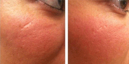 Scar Removal Dubai Before and After