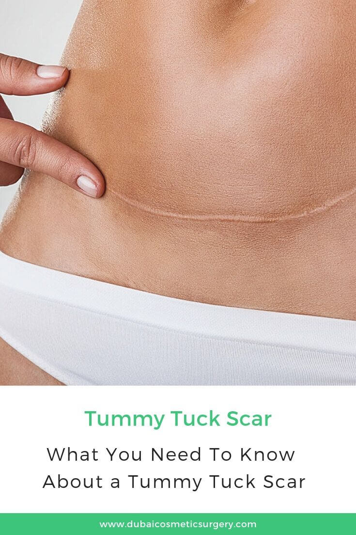 Know About Tummy Tuck Scar Dubai Cosmetic Surgery®