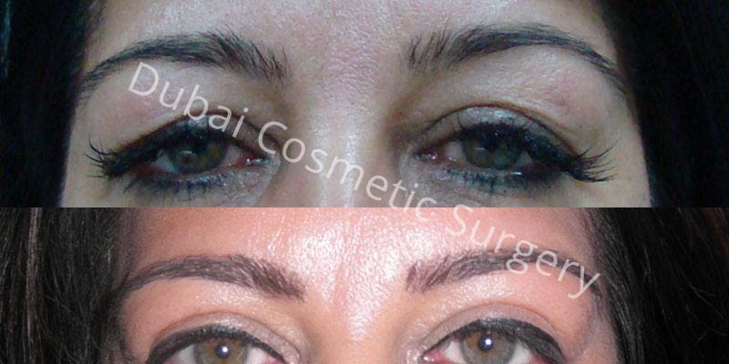 Eyebrows Treatment before & after 24