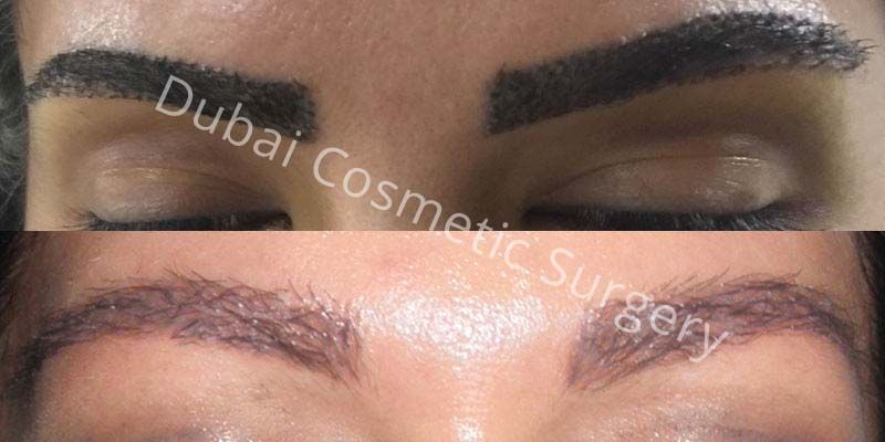 Eyebrows Treatment before & after 25