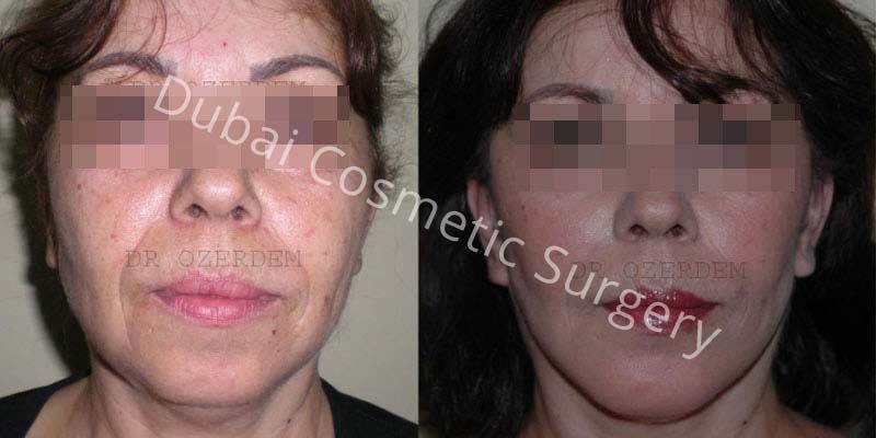 Face Lift before & after