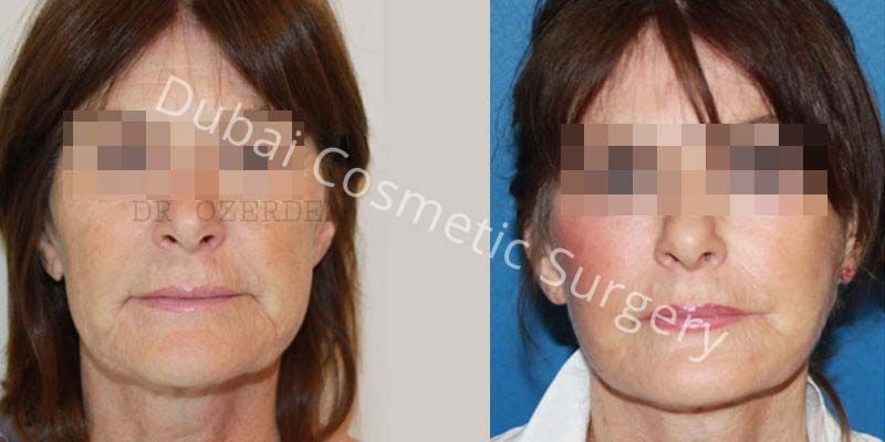 Face Lift before & after 12