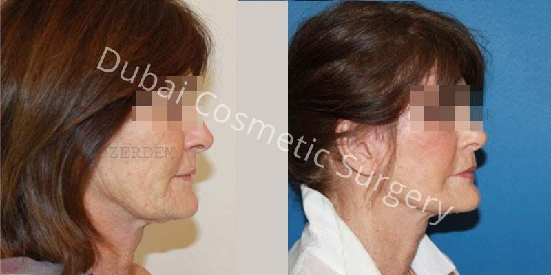Face Lift before & after 13