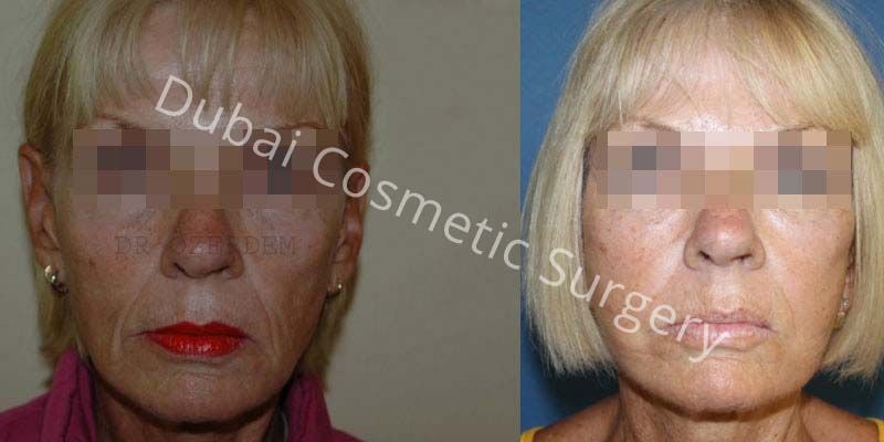 Face Lift before & after 15