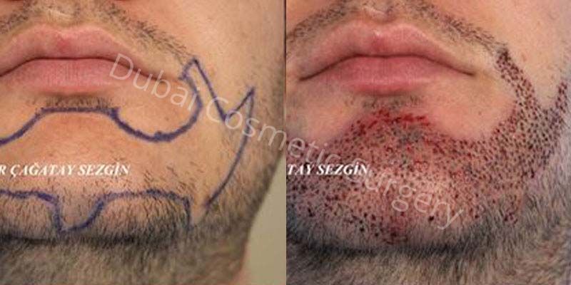 Beard Transplant Cost - Dubai