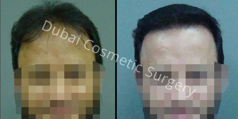 Before And After | Dubai Cosmetic Surgery