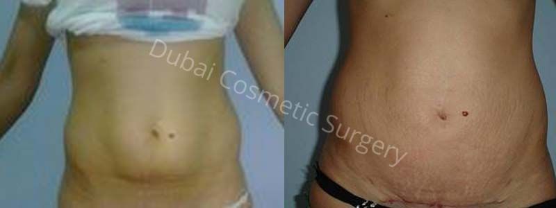 Liposuction treatment