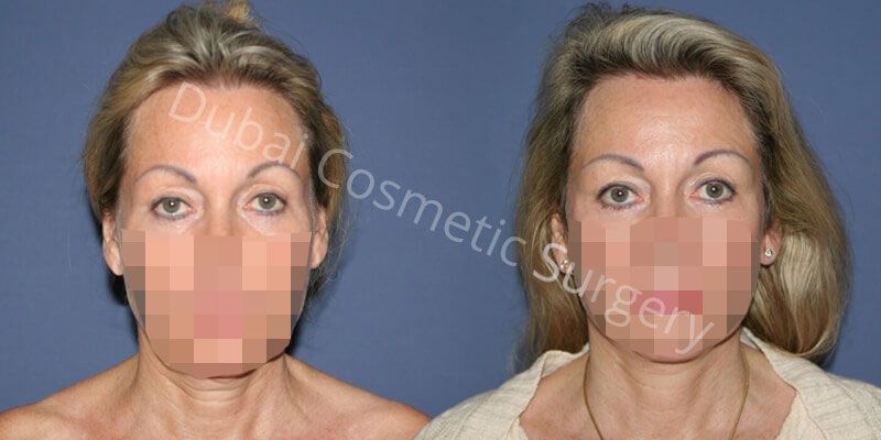 Neck Lift before & After 1
