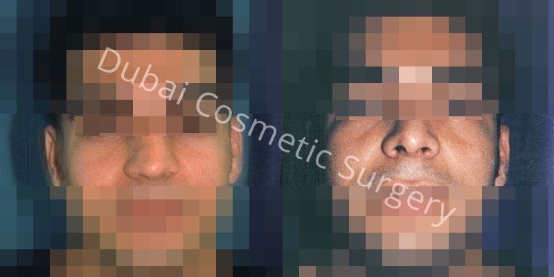 Nose Surgery Before After 13