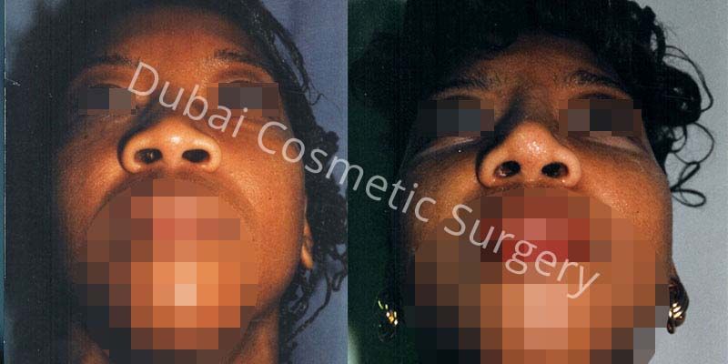 Nose Surgery Before After 15
