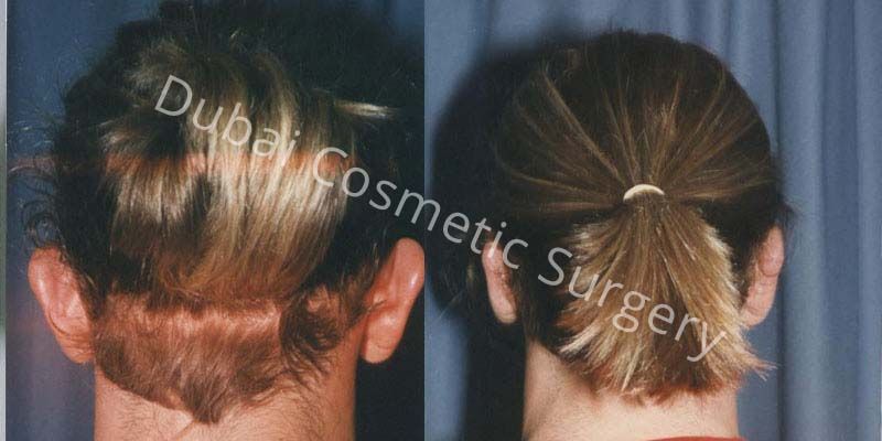 Otoplasty Before and After Results