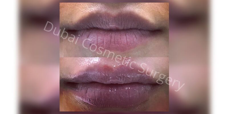 lip augmentation before & after