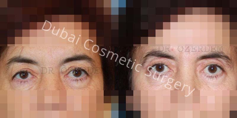 Eyelid Surgery Before & After 08