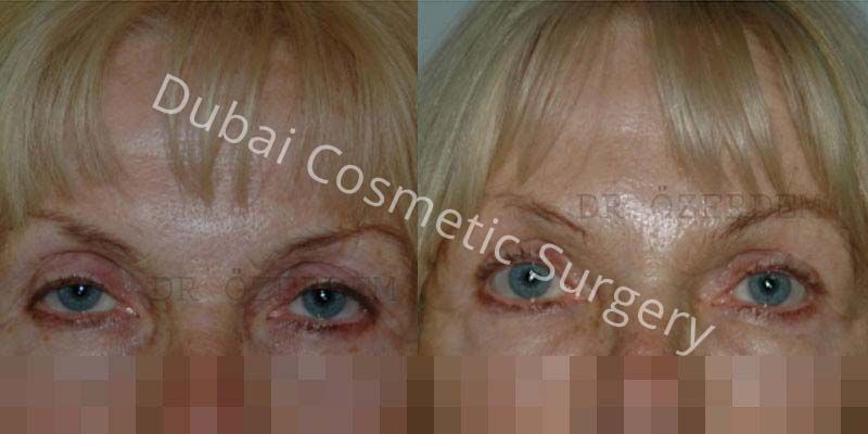 Eyelid Surgery Before & After 16