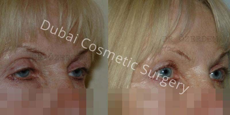 Eyelid Surgery Before & After 17