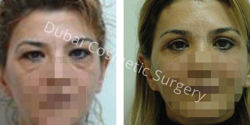 Eyelid Surgery Before & After 06