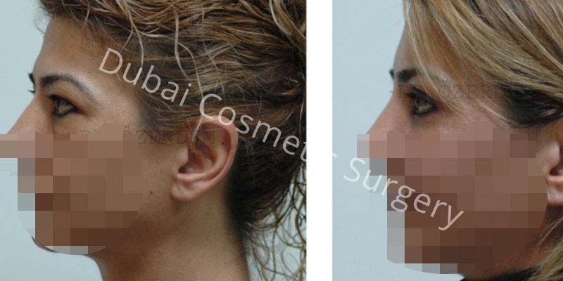 Eyelid Surgery Before & After 07