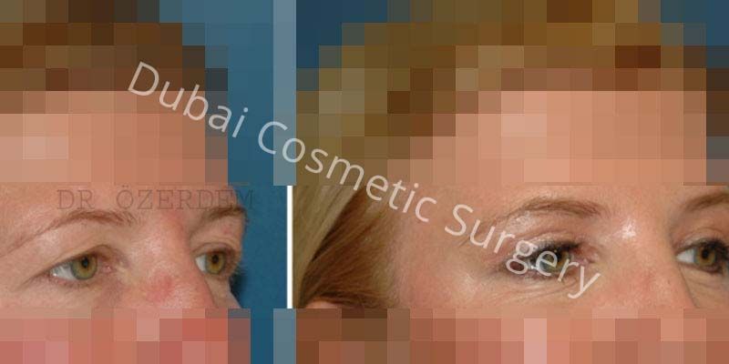 Eyelid Surgery Before & After 11