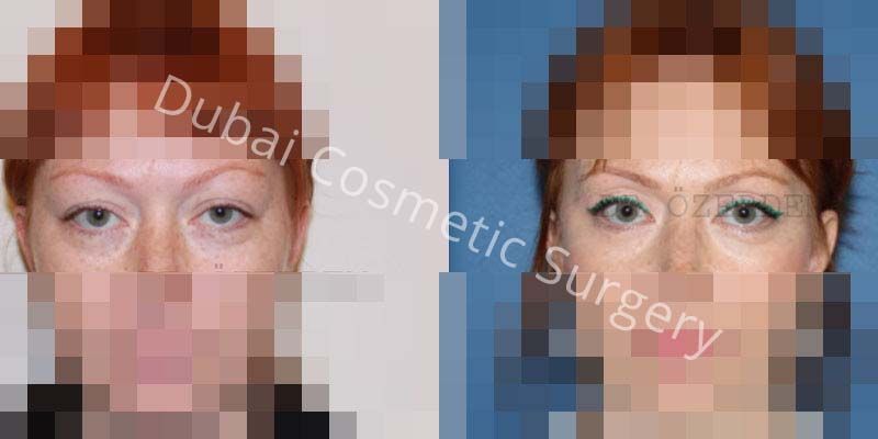 Eyelid SurgeryEyelid Surgery Before & After13