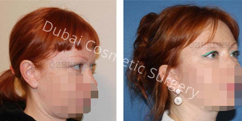 Eyelid Surgery Before & After 14