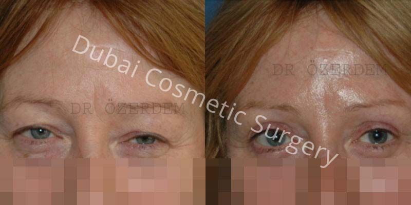 Eyelid Surgery Before & After 15