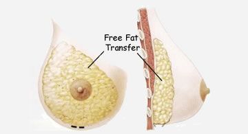 AFT Breast Augmentation