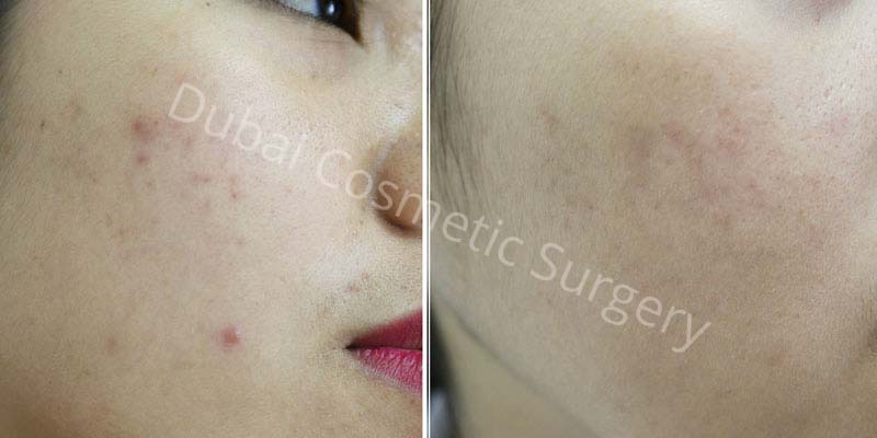 Acne Treatment Patient Before & After 3