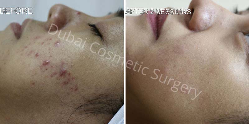 Acne Treatment Patient before & after 6