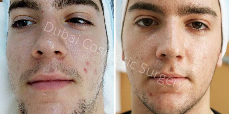 Acne Treatment Patient before & after 9
