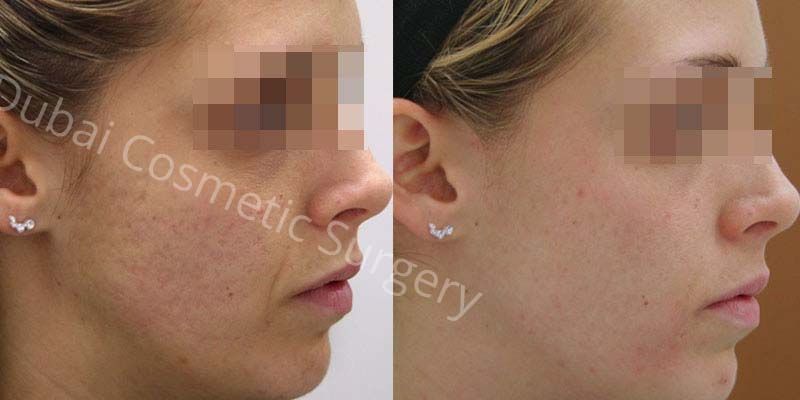 acne scars before after 2