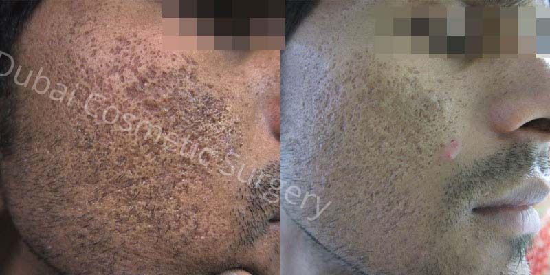 Acne Treatment Dubai | Acne Scar Removal