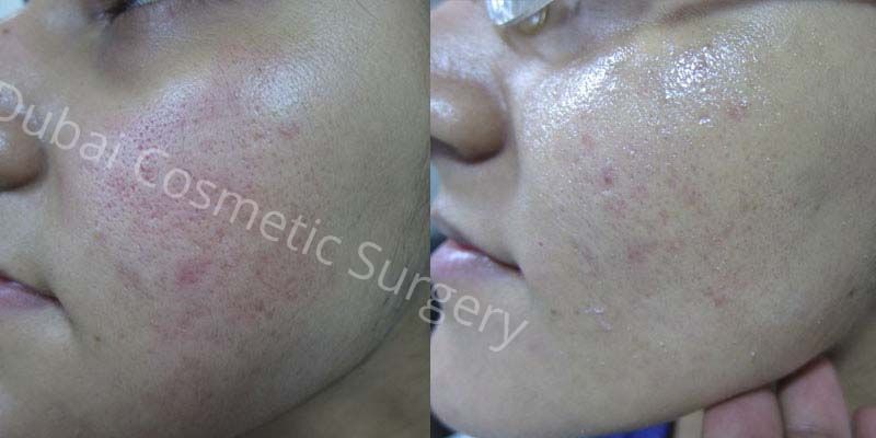 acne scars before after 6
