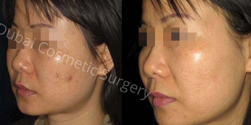 The Most Effective Treatment for Acne Scars Dubai