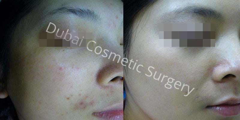 acne-vulgaris before after1