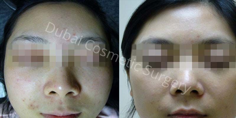 acne-vulgaris before after 2