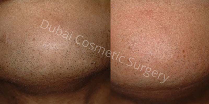 hair removal before after 3
