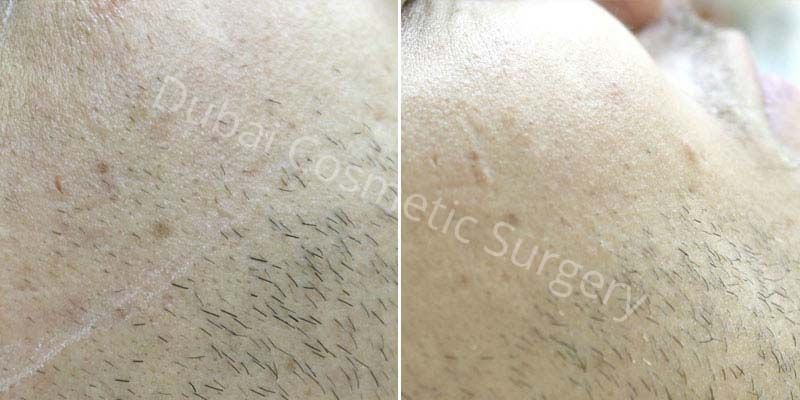 Laser Hair Removal before & after 4