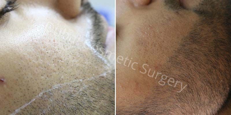Laser Hair Removal Before & After 6