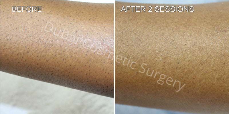 Laser Hair Removal Before & After 7