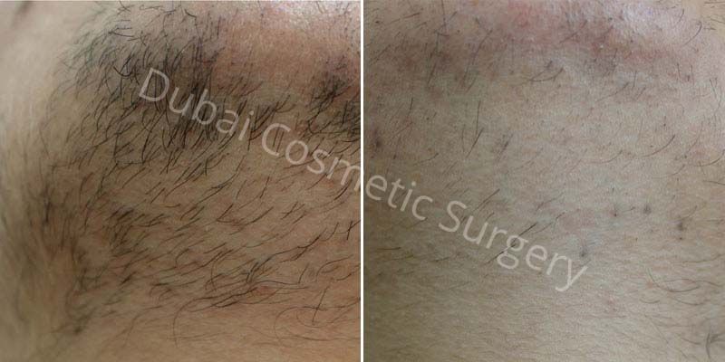 Laser Hair Removal Before & After 8