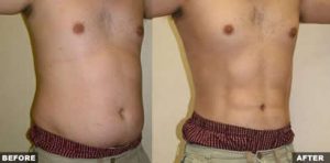 Liposuction Before & After 2