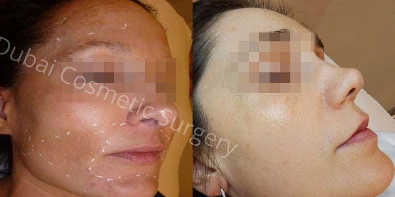 melasma treatment before after