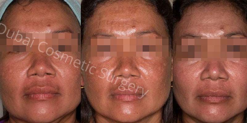 melasma treatment before after 1