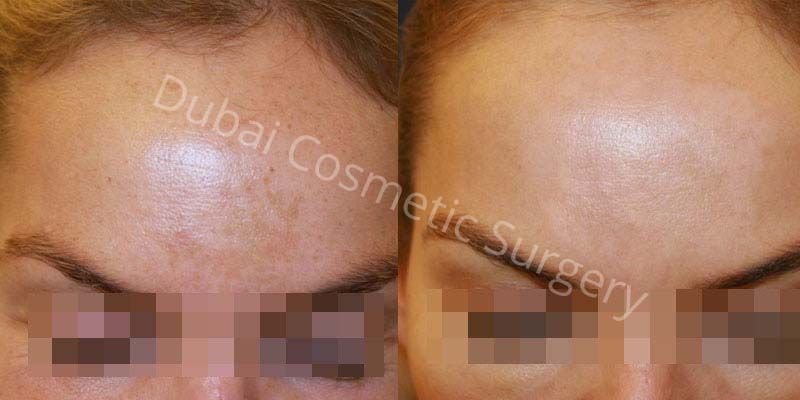 melasma treatment before after 4