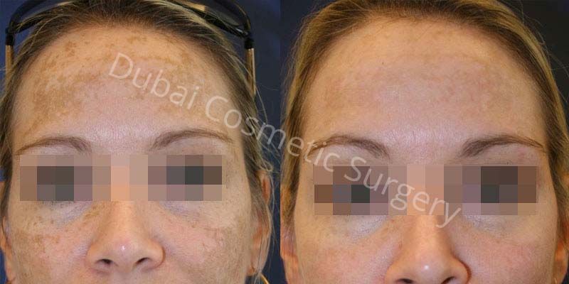 melasma treatment before after 5