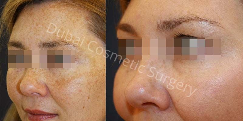Melasma treatment before after 6