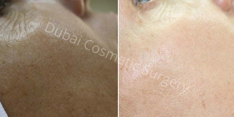 Skin Rejuvenation before & after 1