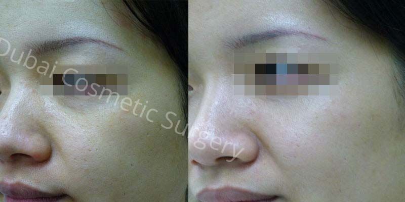 Skin Whitening Before And After